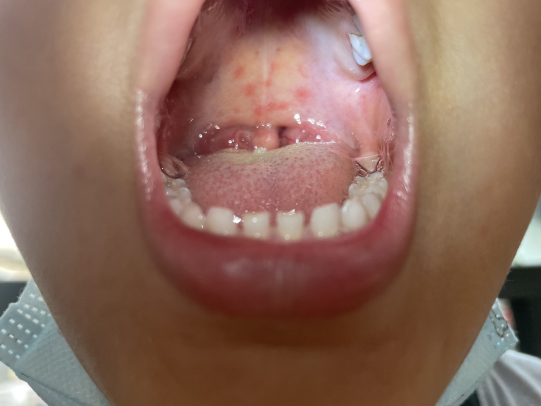 疱疹性咽峡炎主要的症状有突发高热,咽部见小红点,随后成小水泡,最后