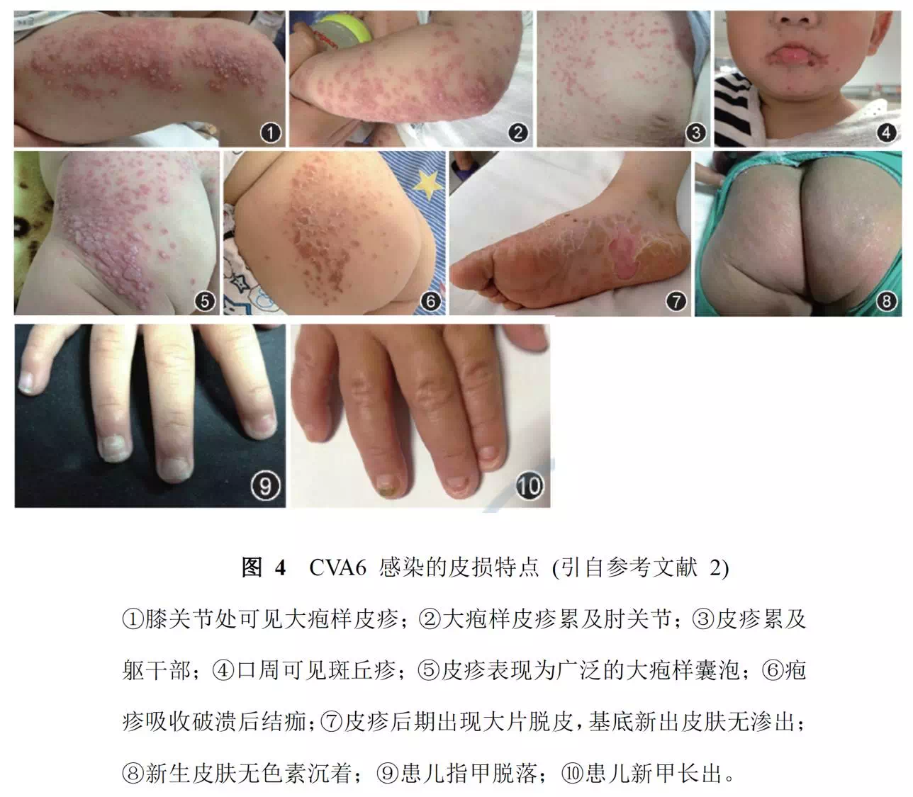 接触史;·好发于5岁以下儿童,尤其多发于3岁以下儿童;·除典型皮疹外